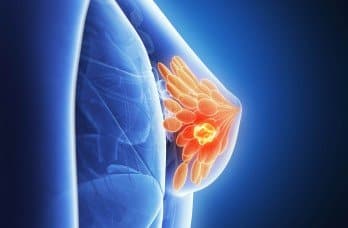 breast cancer survival guide